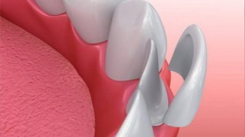 Choose Restorative Dentistry to Replace or Repair Teeth