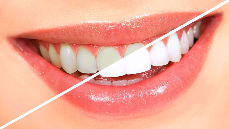 Learn About the Importance of Teeth Cleaning in Del City, OK