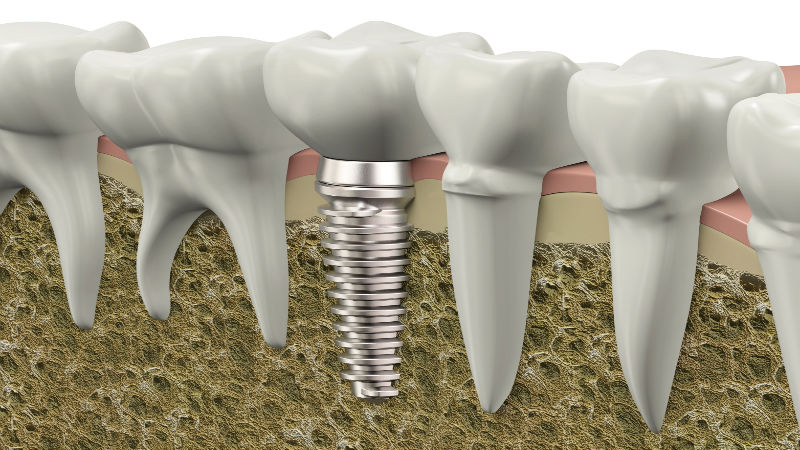 Specifics of Dental Implants in Keizer OR