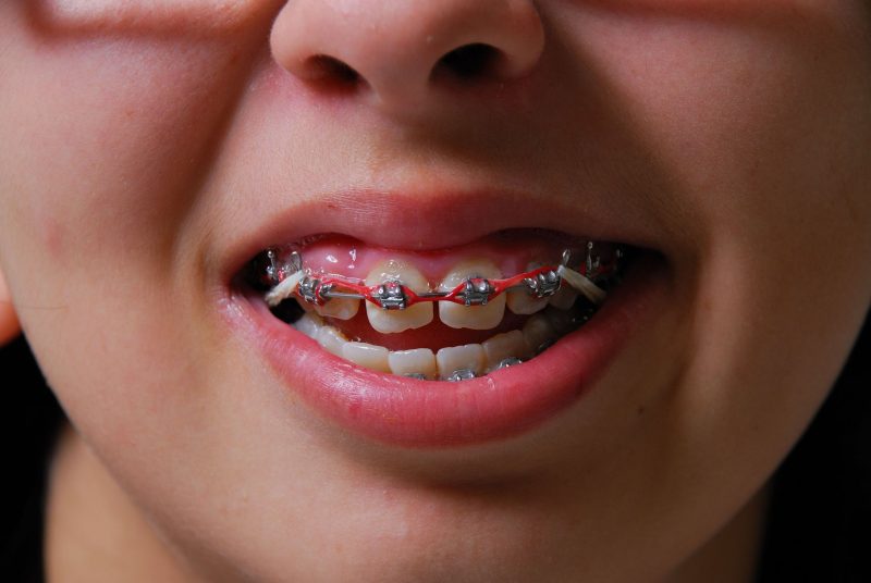 When Should You See An Orthodontist?