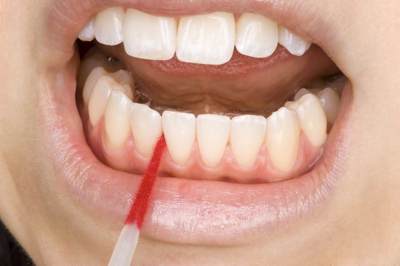 Using Dental Care Services in Ocala When Sensitive Teeth Are An Issue