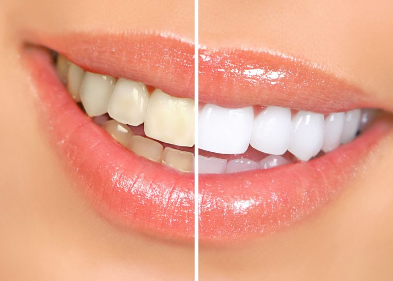Services Provided By A Cosmetic Dentist In Annapolis