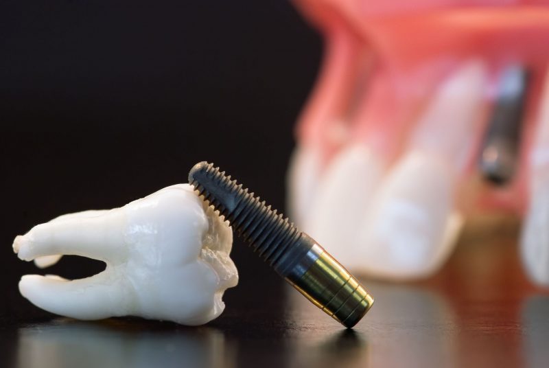Why You Should Choose Dental Implants in Summit, NJ
