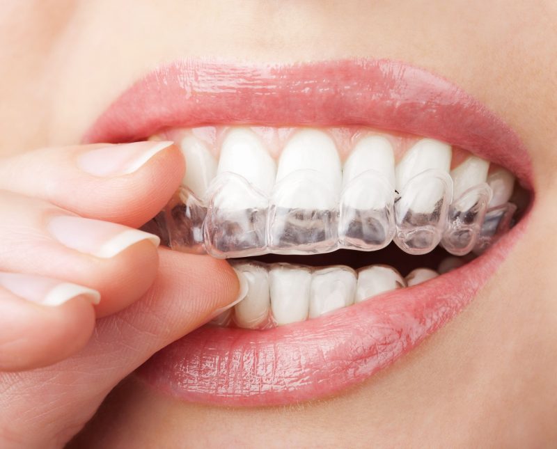 Is an Invisalign Treatment in Long Beach, CA Right for You?