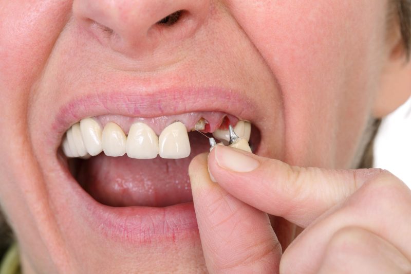Get Your Dental Veneers in Roseburg, OR, From Your Local Family Dentist