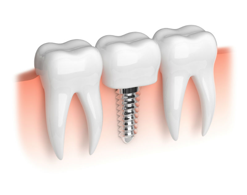 The Most Common Reasons to Undergo Professional Teeth Whitening in Parker